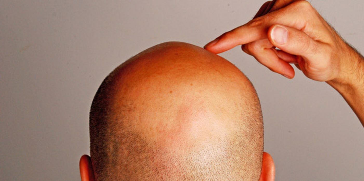 Haarausfall kann bei Männern erblich bedingt schon in jungen Jahren einsetzen.