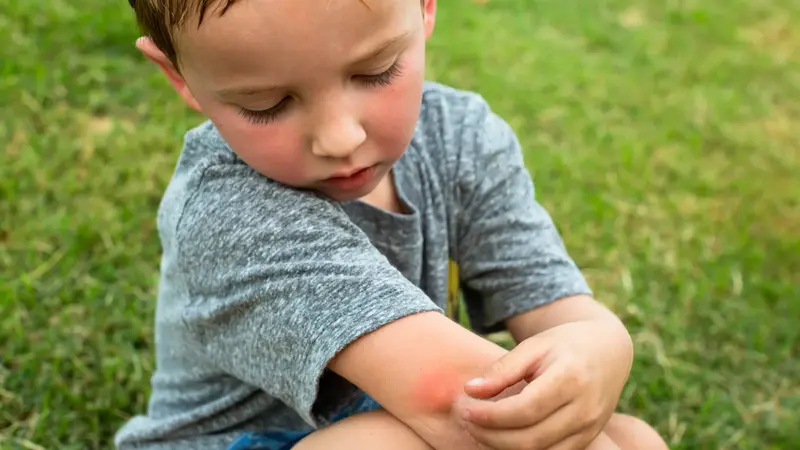 Kleiner Junge, hat einen Insektenstich am Arm.