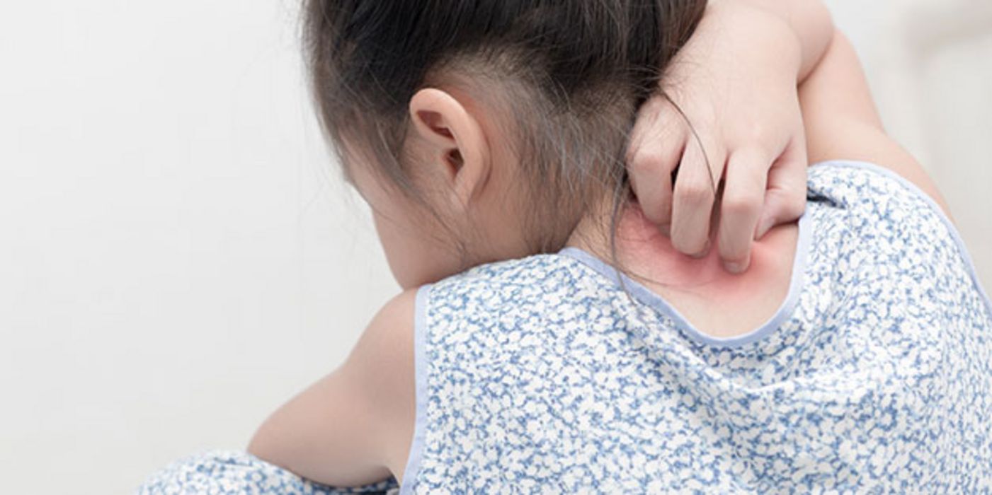 Neurodermitis tritt häufig im Kindesalter auf.
