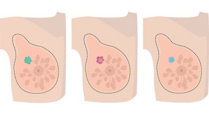 Illustration; drei Ansichten einer Brust mit jeweils einem unterschiedlichen Krebszell-Typ