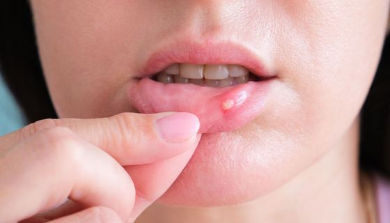 Frau, zeigt eine Aphthe auf ihrer Lippe.