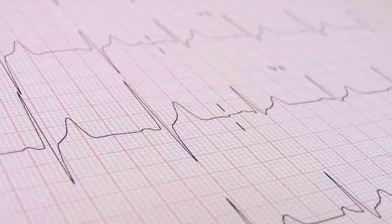 EKG-Kurve auf Millimeterpapier aufgezeichnet.