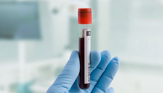 In westlichen Ländern ist der Cholesterinspiegel in den vergangenen Jahren gesunken.