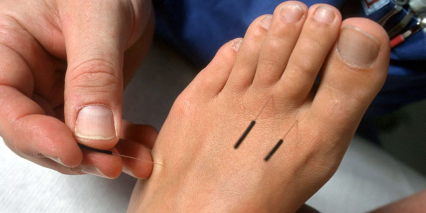 Fuß mit Akupunkturnadeln