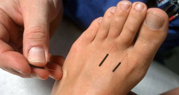 Fuß mit Akupunkturnadeln