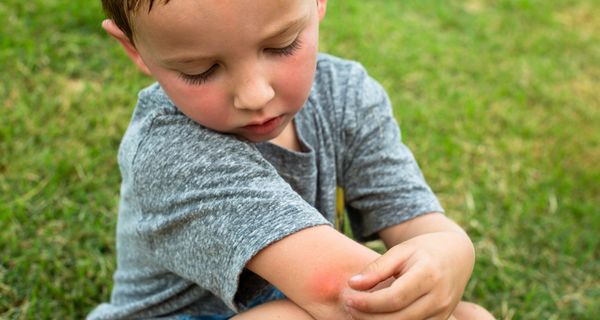 Kleiner Junge, hat einen Insektenstich am Arm.