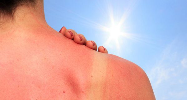 2015 hatten 40 Prozent der Deutschen einen Sonnenbrand.