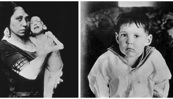 Historische Bilder eines der ersten Patienten, der mit Insulin behandelt wurde.