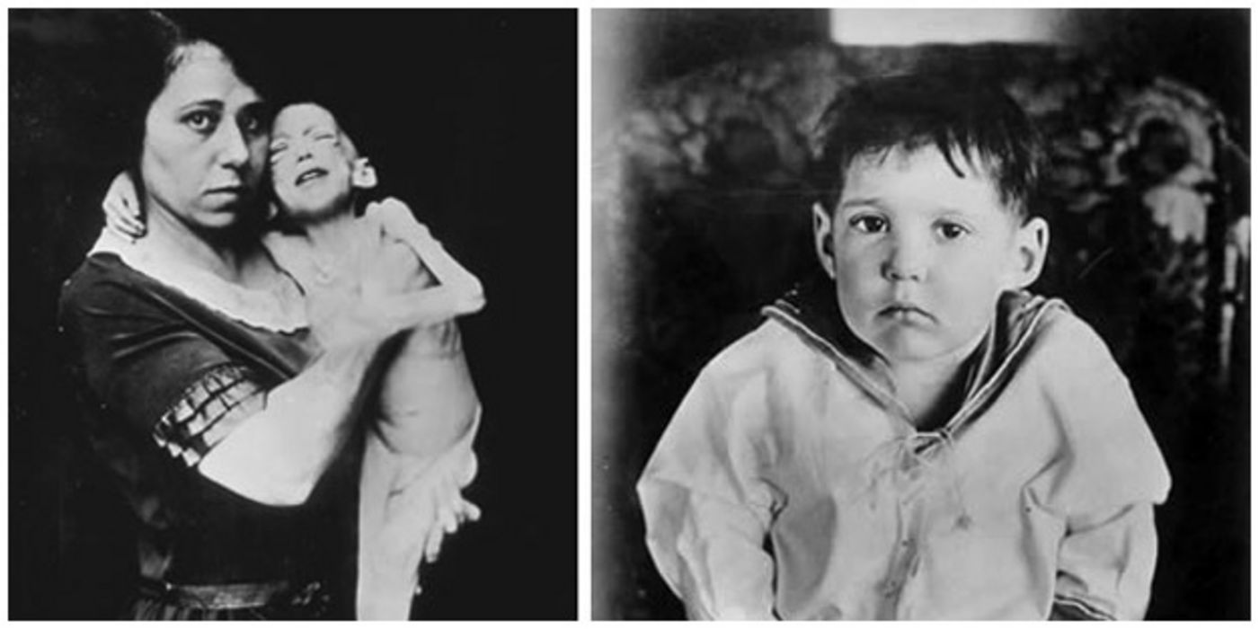 Historische Bilder eines der ersten Patienten, der mit Insulin behandelt wurde.