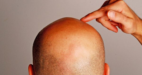 Haarausfall kann bei Männern erblich bedingt schon in jungen Jahren einsetzen.
