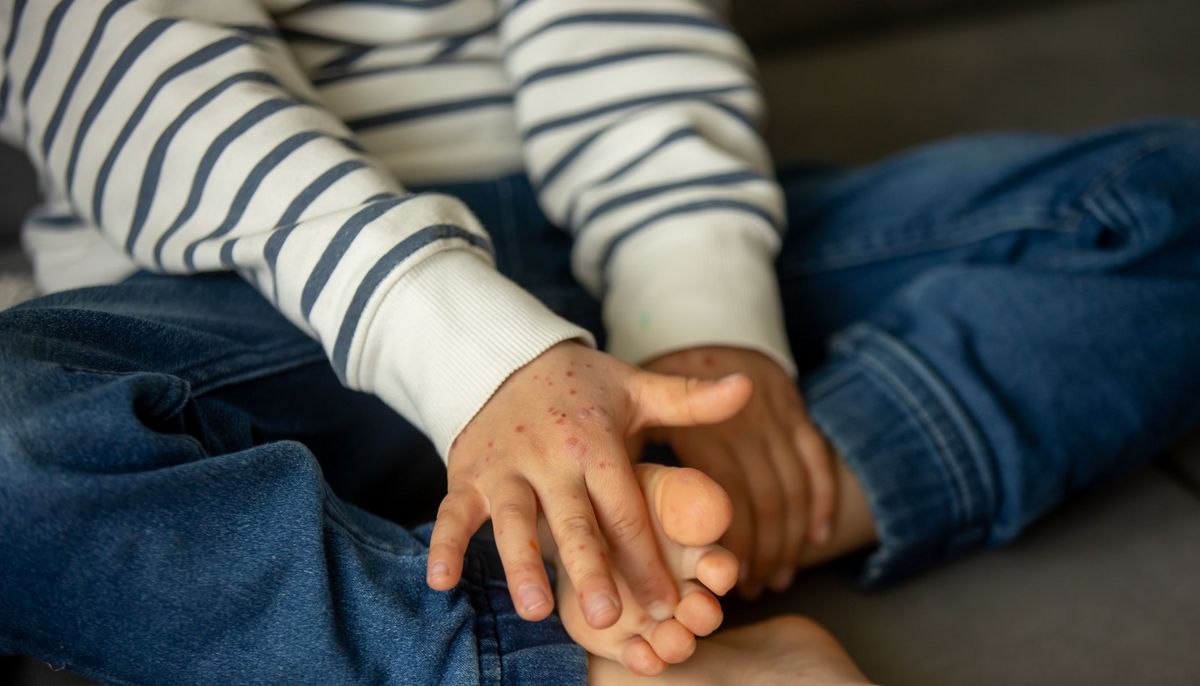 Hand Mund Fuß Leichter Verlauf Hand-Fuß-Mund-Krankheit: Symptome, Verlauf und Behandlung | aponet.de