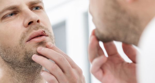 Mann betrachtet seinen Lippenherpes im Spiegel.