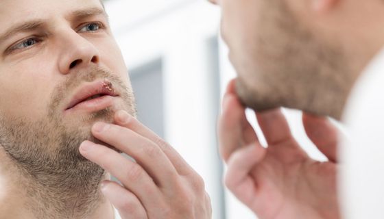 Mann betrachtet seinen Lippenherpes im Spiegel.