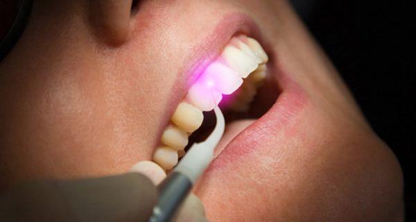 Ein Gesicht einer Frau. Die Zähne der Frau werden mit einem Laser behandelt.