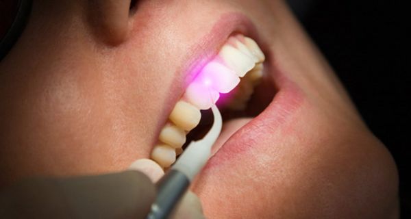 Ein Gesicht einer Frau. Die Zähne der Frau werden mit einem Laser behandelt.
