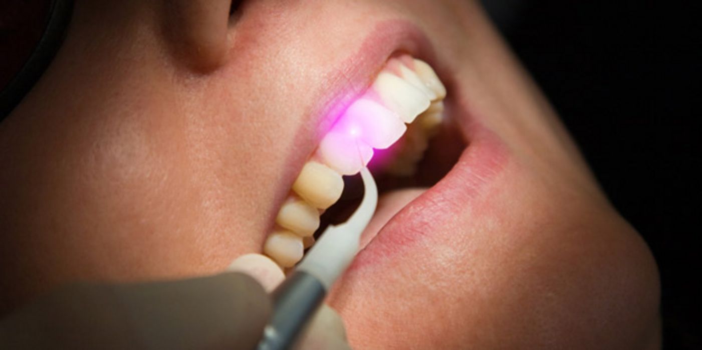 Ein Gesicht einer Frau. Die Zähne der Frau werden mit einem Laser behandelt.