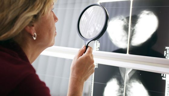 Diagnose Brustkrebs: Häufig werden falsche Befunde gemacht.