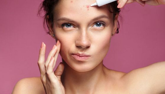 Acne comedonica und andere Arten lassen sich mit Medikamenten gut behandeln.