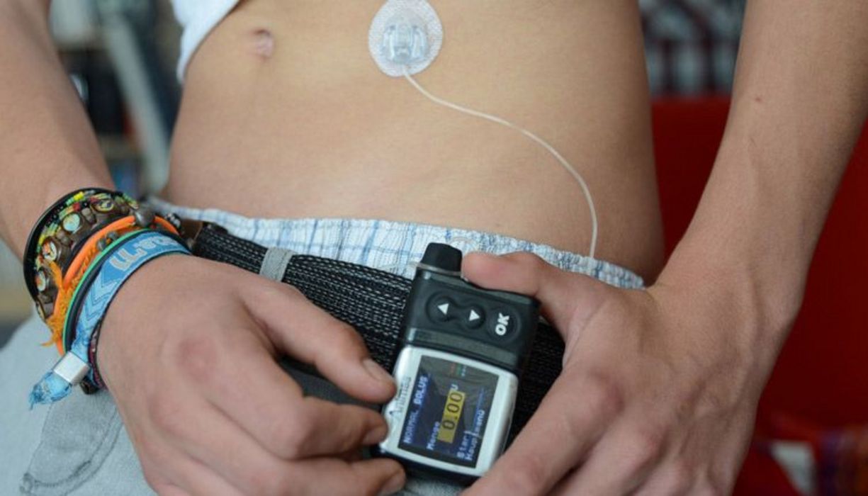 Ausschnittfoto: Insulinpumpe an der Hüfte eines jungen Menschens
