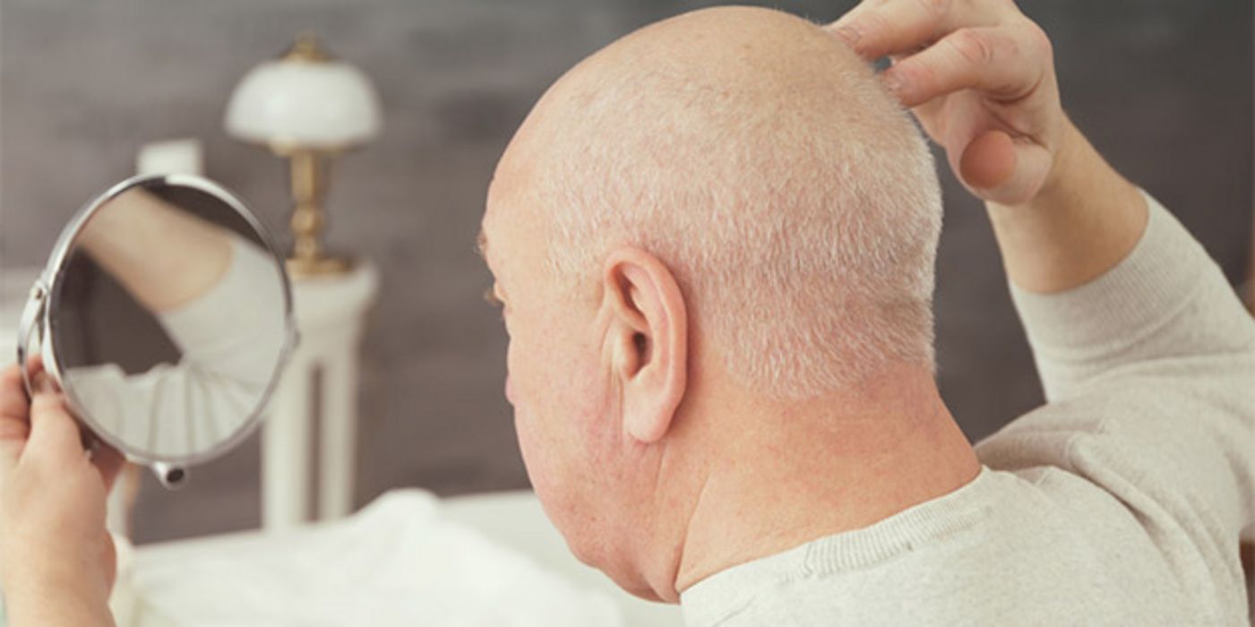 Frühzeitiger Haarausfall ist häufig erblich bedingt.