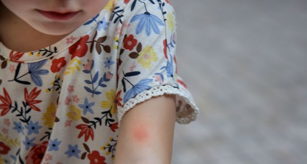 Mädchen mit einem Insektenstich auf dem Arm