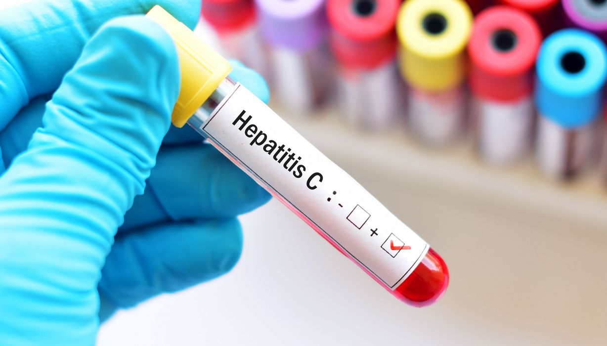 Blutprobe mit Hepatitis-C-Test.