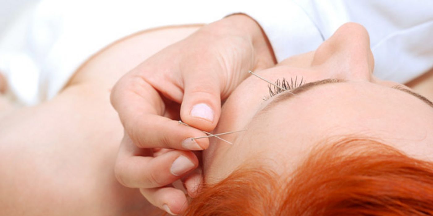 Kopfansicht von schräg oben einer liegenden jungen Frau, die Akupunkturnadeln in Stirn und Schläfe gesetzt bekommt