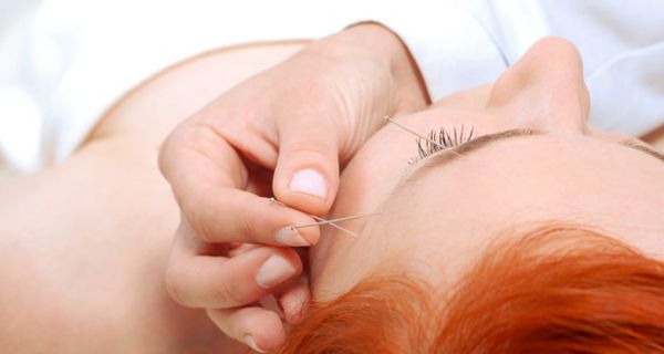 Kopfansicht von schräg oben einer liegenden jungen Frau, die Akupunkturnadeln in Stirn und Schläfe gesetzt bekommt