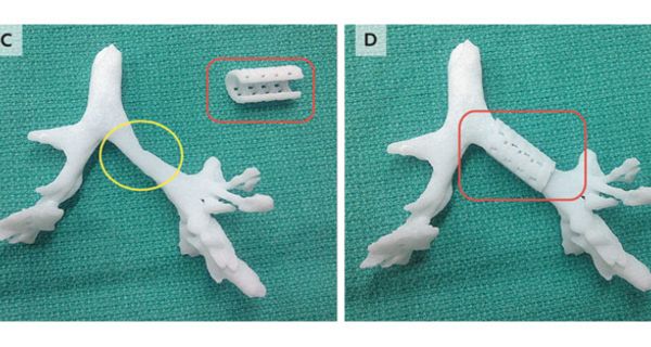 3D-Bronchus