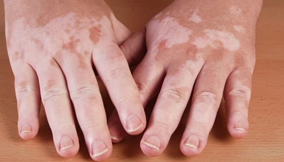Hände mit Vitiligo-Flecken