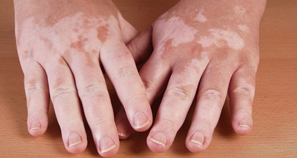Hände mit Vitiligo-Flecken