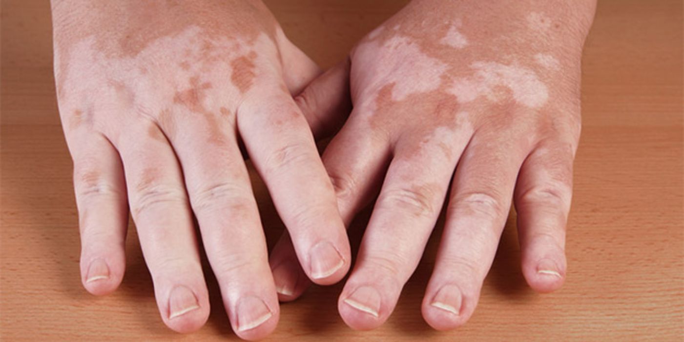 Hände mit Vitiligo-Flecken