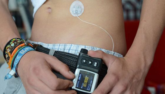In den letzten Jahren nutzen immer mehr junge Typ-1-Diabetiker eine Insulinpumpe.