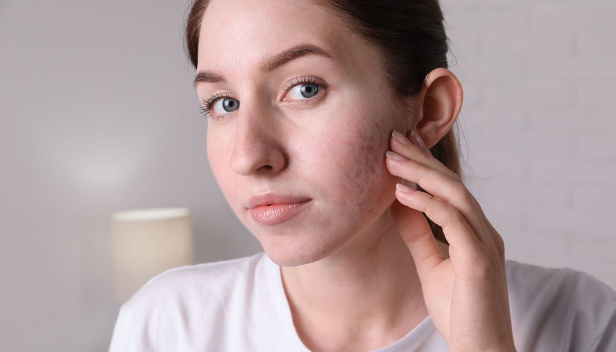 Eine junge Frau hält ihre Hand an die Rötung und die Pusteln in ihrem Gesicht.