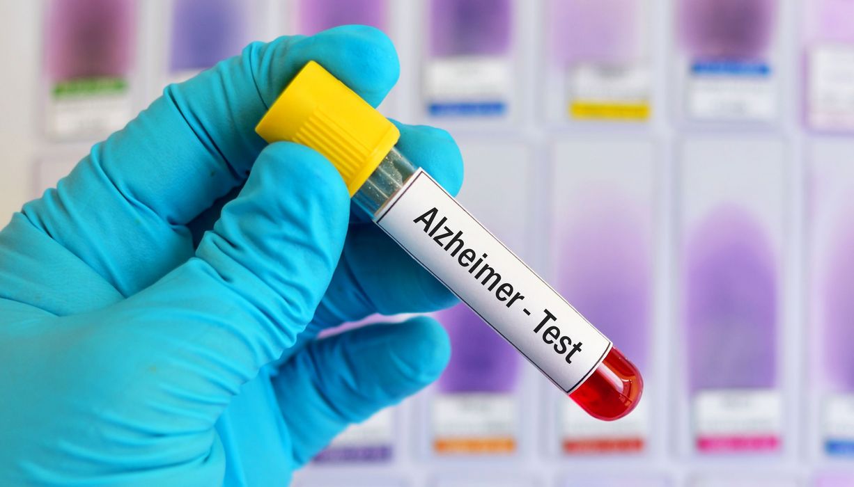 Blutröhrchen mit der Aufschrift "Alzheimer-Test". 