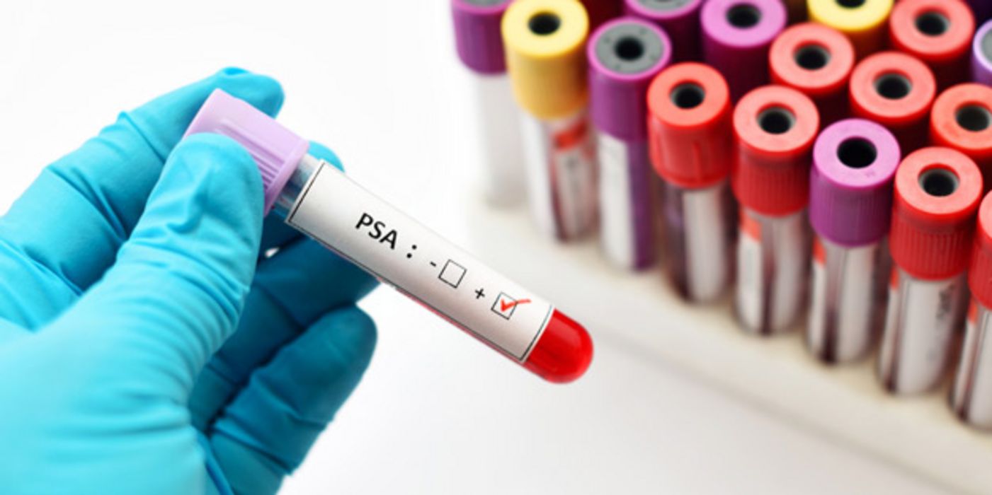 Ein PSA-Test eignet sich nicht für ein generelles Prostatakrebs-Screening.