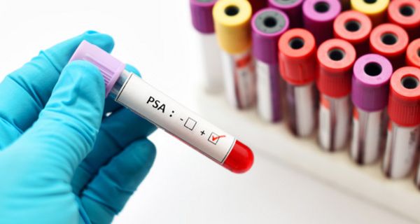 Ein PSA-Test eignet sich nicht für ein generelles Prostatakrebs-Screening.