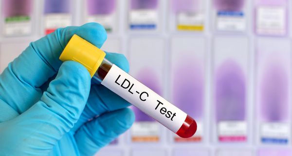 Arzt, hält eine Blutprobe mit der Aufschrift "LDL-C Test" in der Hand.
