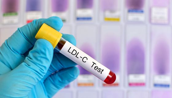 Arzt, hält eine Blutprobe mit der Aufschrift "LDL-C Test" in der Hand.