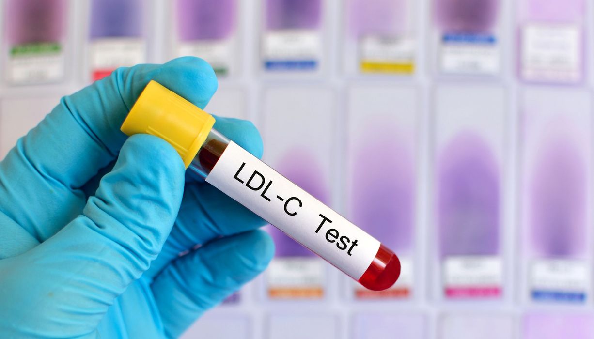 Arzt, hält eine Blutprobe mit der Aufschrift "LDL-C Test" in der Hand.