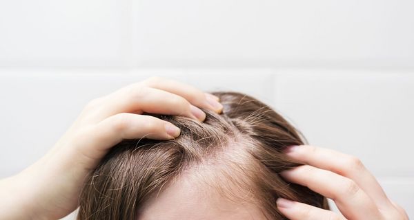 Frau mit Haarausfall.