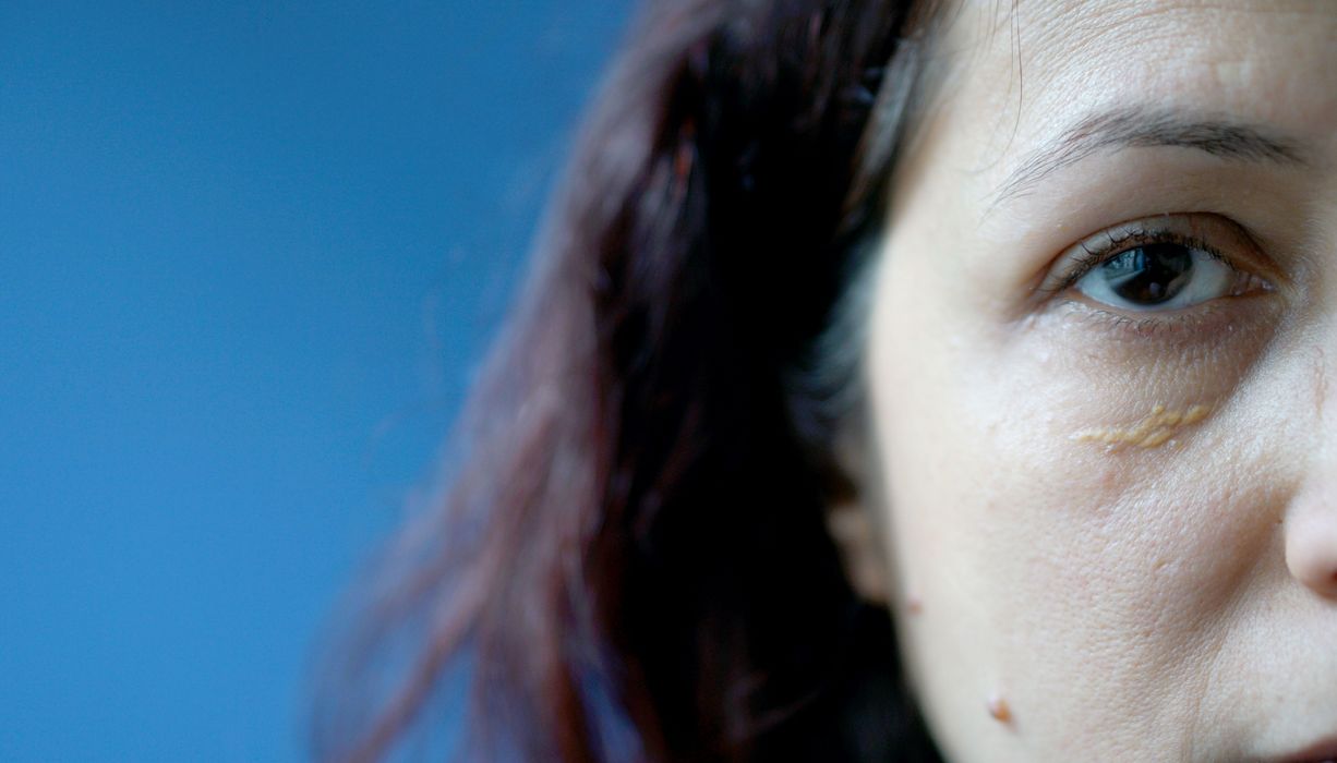 Frau mit gelben Flecken am Augenlid