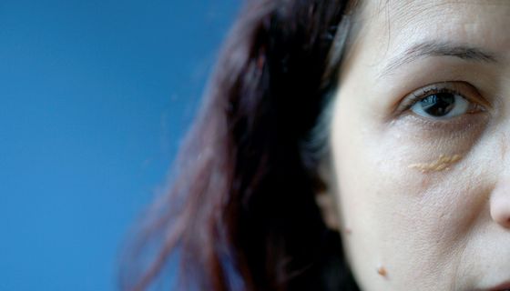 Frau mit gelben Flecken am Augenlid