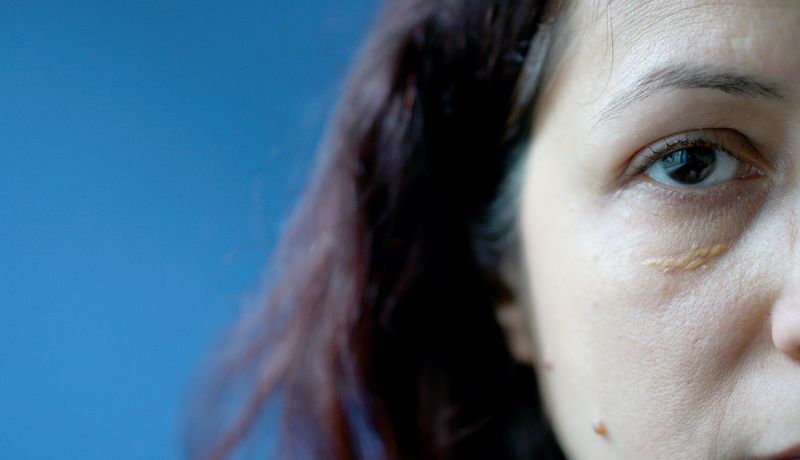 Frau mit gelben Flecken am Augenlid