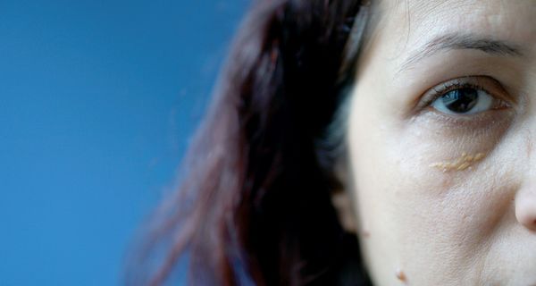 Frau mit gelben Flecken am Augenlid