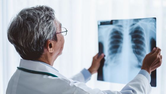 Arzt betrachtet Röntgenaufnahme der Lunge.