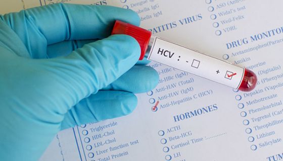 Hepatitis C wird über infiziertes Blut übertragen.