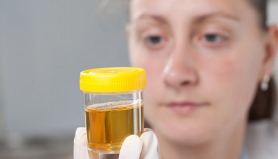 Nahaufnahme: Gesicht Laborkraft im Hintergrund rechts, etwas unscharf, im Vordergrund, etwas links, Becher mit Urin (gelber Deckel), gehalten von weiß behandschuhten Fingern