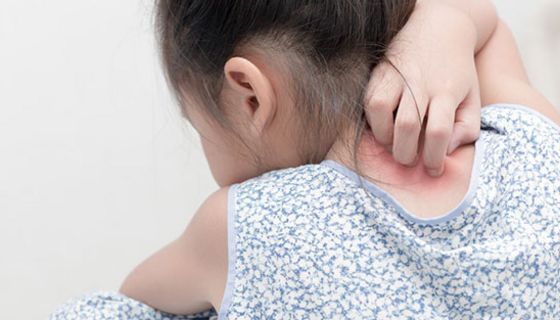 Neurodermitis ist eine häufige Hautkrankheit, die vor allem Kinder betrifft.