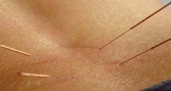 Akupunkturnadeln in der Haut eines Patienten
